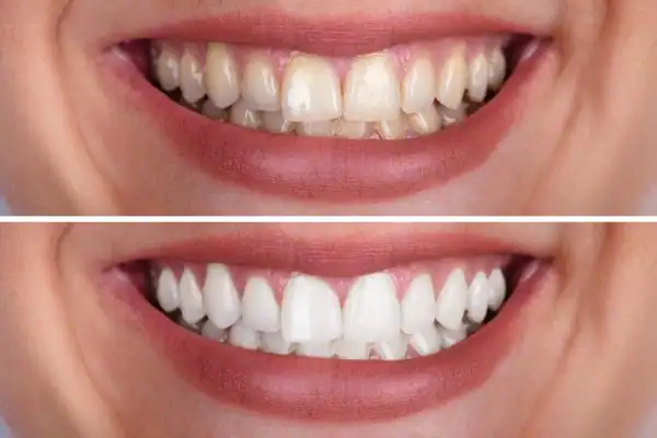 Before and after results of Blue Light Teeth Whitening Waterlooville